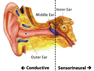 Sensorineural hearingLoss