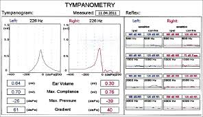 Tympanometry data